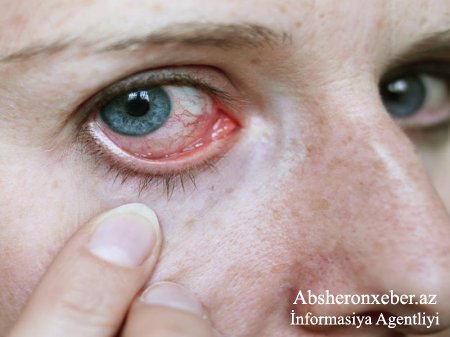 Göz allergiyasını necə azaltmalı? - Üsullar